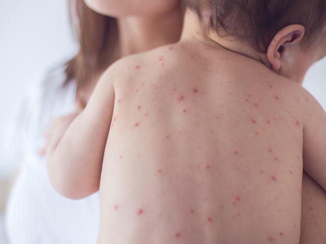 More than 400 cases of chickenpox, potentially more