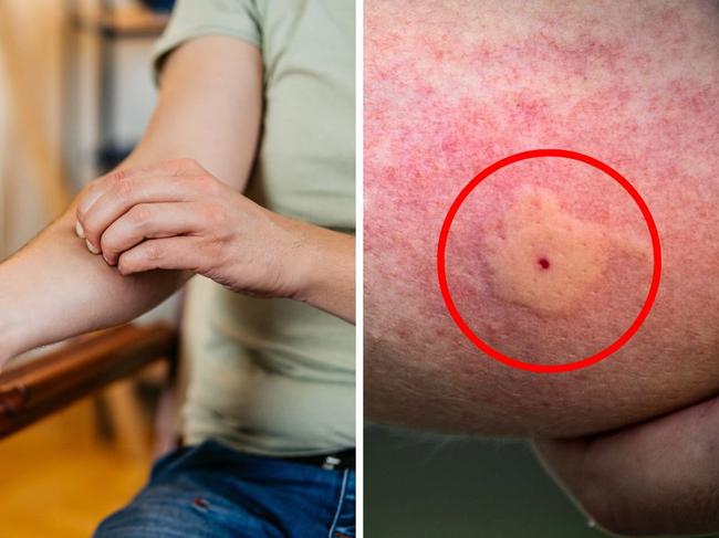 An Aussie mozzie expert has shed light on why some people may have worse reactions to mosquito bites than others. Picture: Instagram