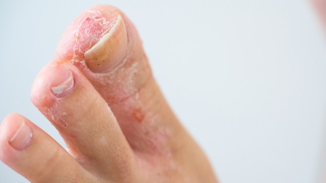 ‘COVID toes’ is the new symptom of coronavirus | body+soul