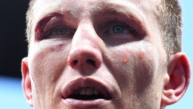 New WBO welterweight world champion Jeff Horn copped a nasty cut over his eye during his fight with Manny Pacquiao.