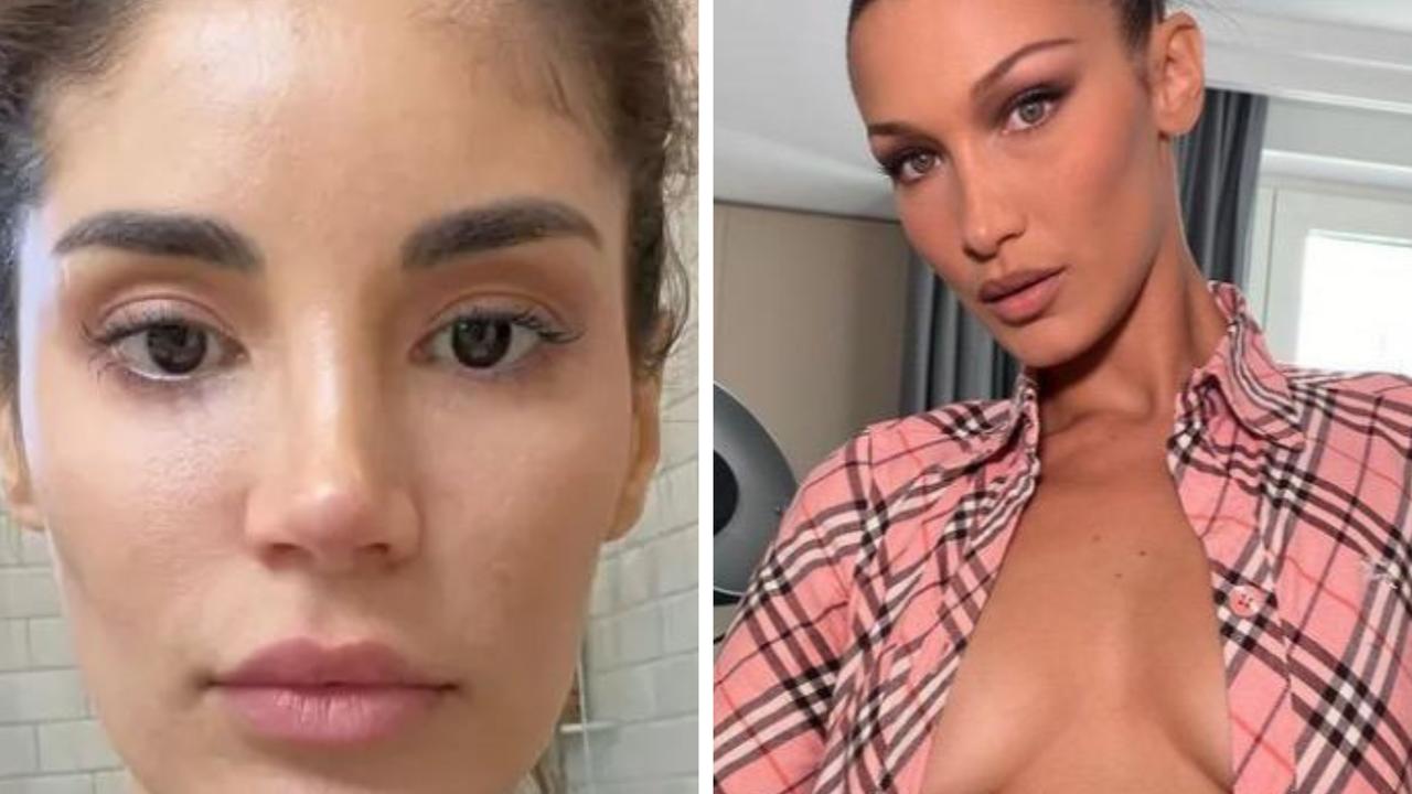 Bella Hadid-inspired surgery goes viral