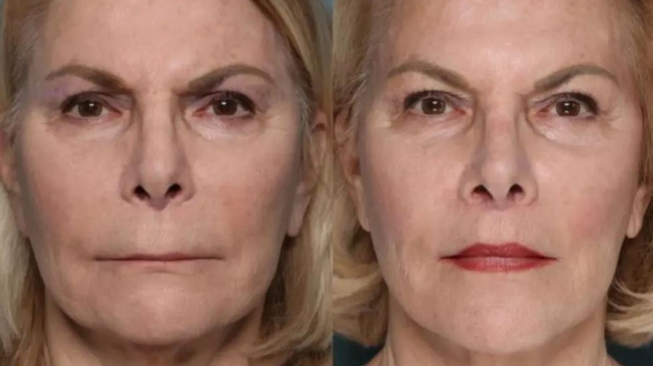 A patient of Dr Louis P Bucky who had a lip lift, before (left) and after the procedure. Picture: Dr Louis P Bucky