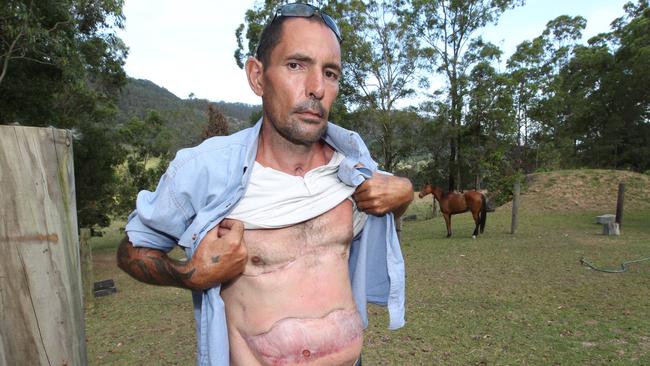 Surfers Paradise Shooting Victim Mr Hylton Miller pictured at his Wongawallen home ,angry at Cr Douglas for calling him a Vigilante for wanting to set up a private security force on the Gold Coast. showing the damage done from his shooting .