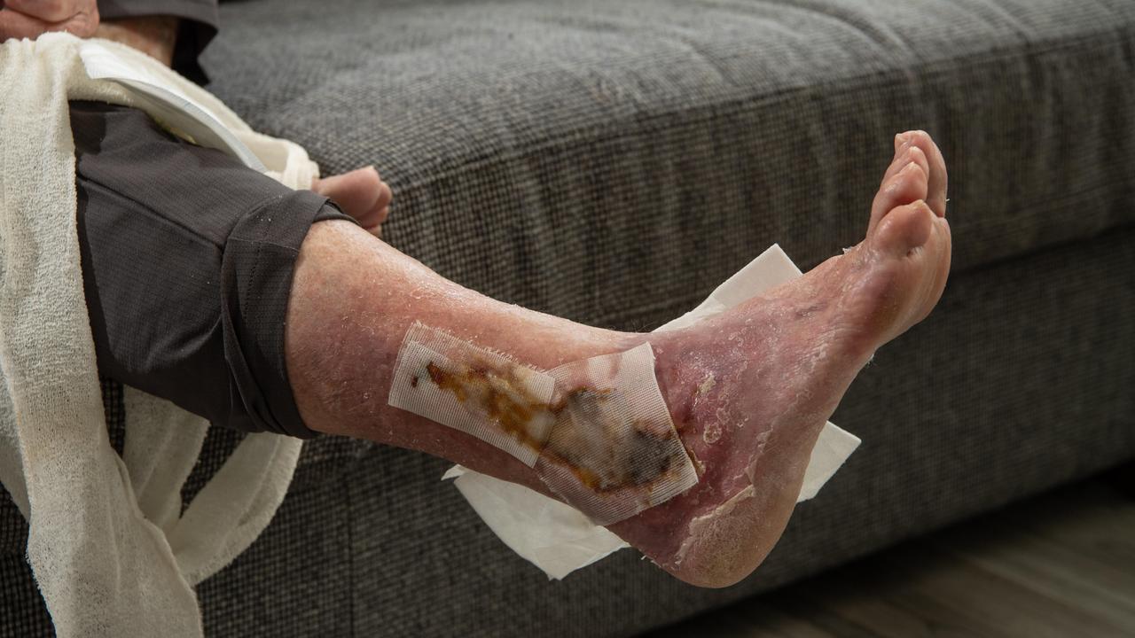 Victorian Anne Hunt, who was recently diagnosed with Buruli Ulcer. Picture: Brad Fleet