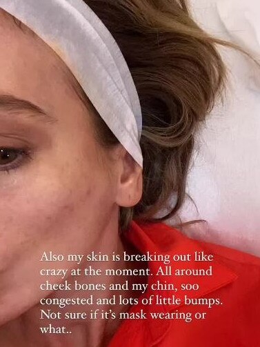 Nadia said her skin had been “breaking out like crazy”. Picture: Instagram/Nadia Bartel.