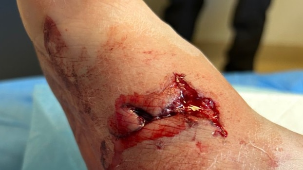 A postie suffered this gruesome wound from a dog attack in Kalgoorlie, WA. Picture: Australia Post