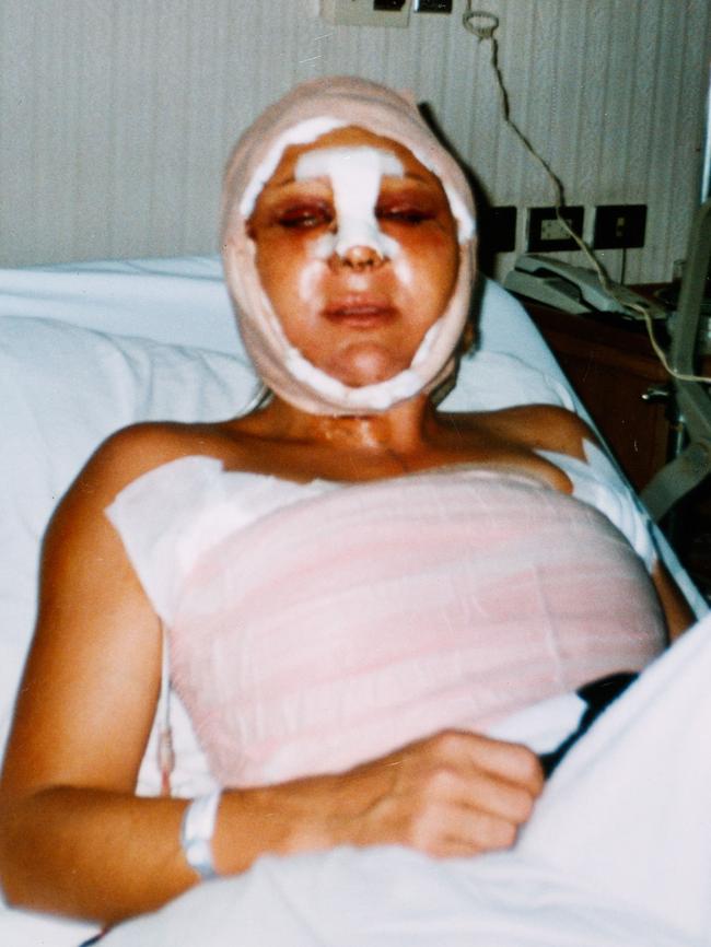 Kirsti Miller after facial feminisation surgery in Bangkok, 2004.