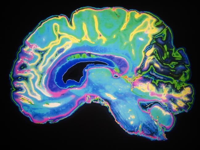 Coloured image of a human brain. Slice of a human brain. stock image. Picture: ThinkStock