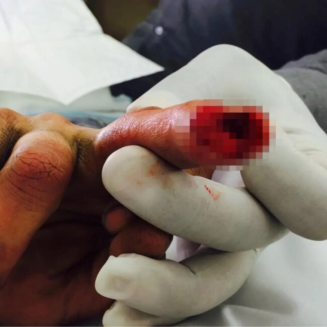 Depp's bloodied finger. Picture: Fairfax County Court.