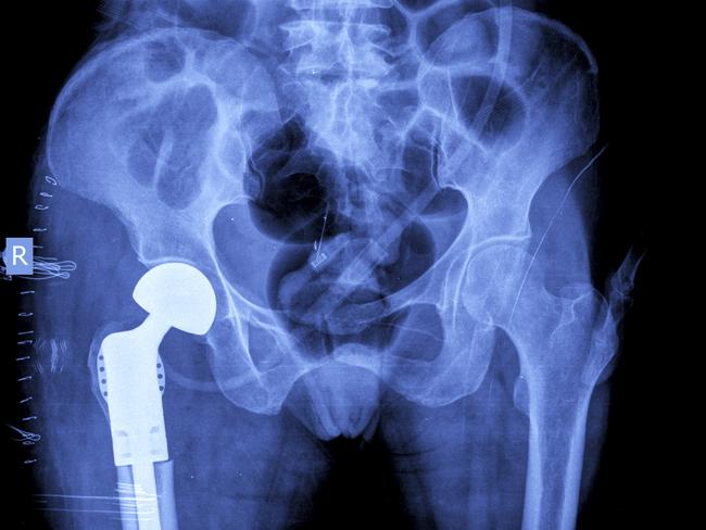 New hip joints now can last beyond 20 years. Picture: iStock