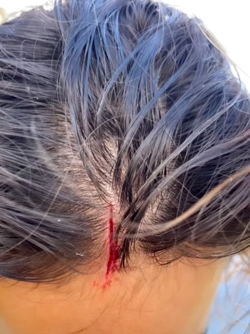 Fitzgibbons herself suffered a fin chop to her forehead during practice in 2022. Picture: Instagram.