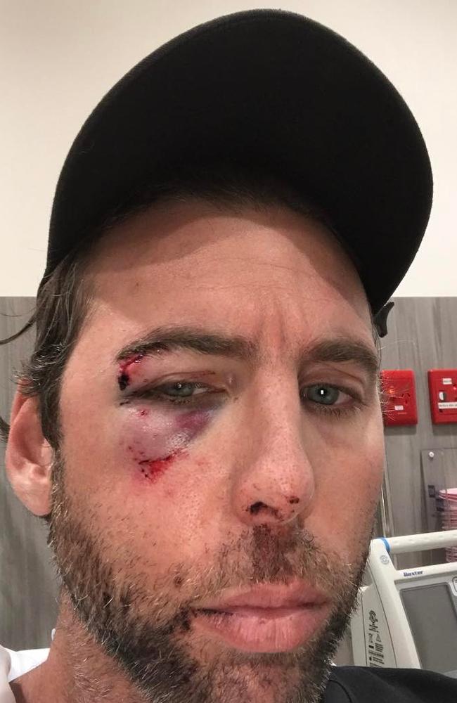 Grant Hackett posted a photo of his bruised face on Instagram accusing his brother of the attack. Picture: Instagram