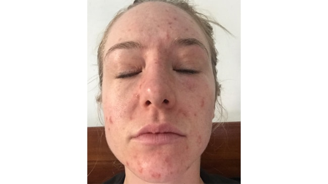 Woman who developed 'catastrophic' acne after quitting the contraceptive  pill goes make-up free to help other sufferers – The Irish Sun