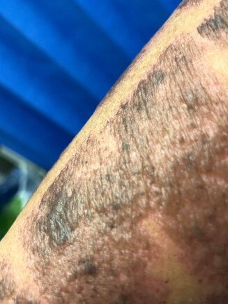 An example of burns caused by laser due to an inexperienced practitioner supplied by the Aesthetics Practitioners Advisory Network.