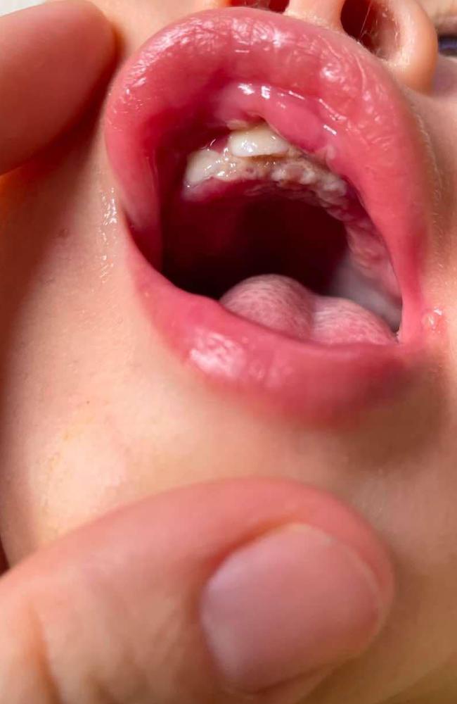 Her son got a cold sore. Picture: Supplied