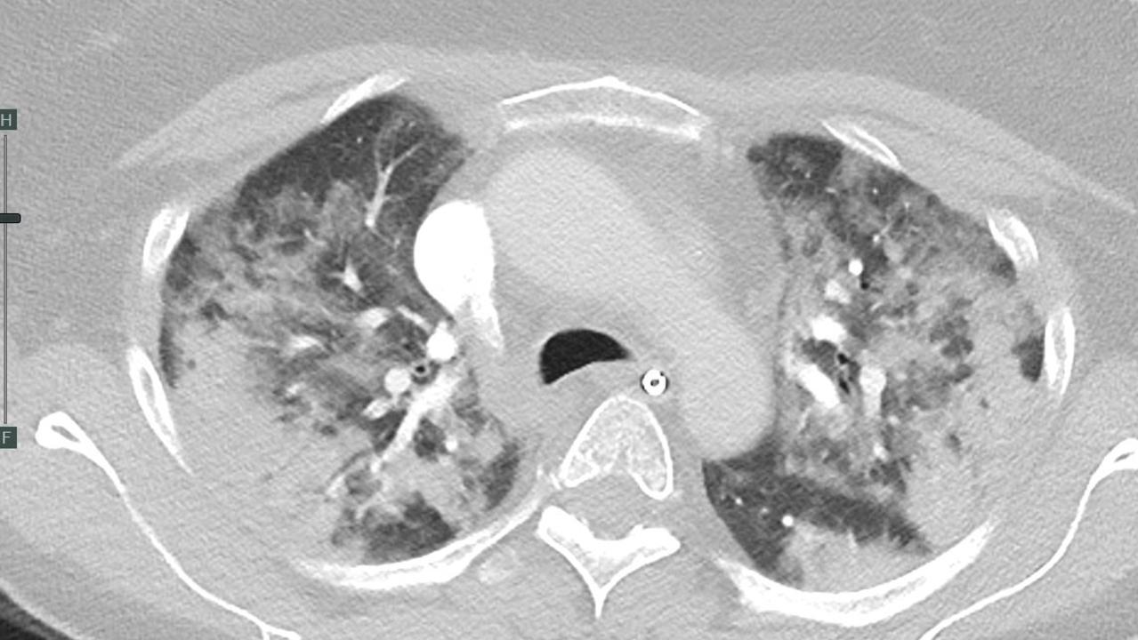 X-rays and CAT scans of a Covid affected patients lungs. Picture: Royal Australian and New Zealand College of Radiologists