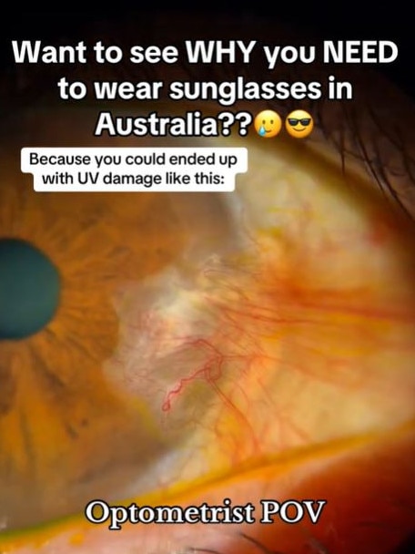 Pterygium develops as a result of repeated UV exposure. Picture: TikTok via @eyelaboptometry