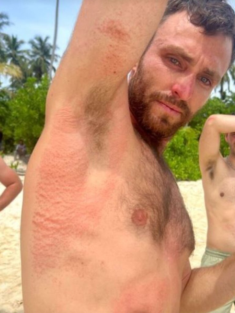 Elliot Foote shows off his injuries after being rescued. Picture: Instagram