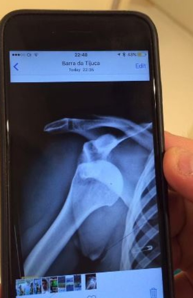 Mickle took to Instagram to post a photo of her X-rayed shoulder.