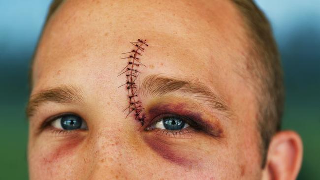 South Sydney Rabbitohs Jason Clark shows off his stitches he received from last weekend's round. Picture. Phil Hillyard