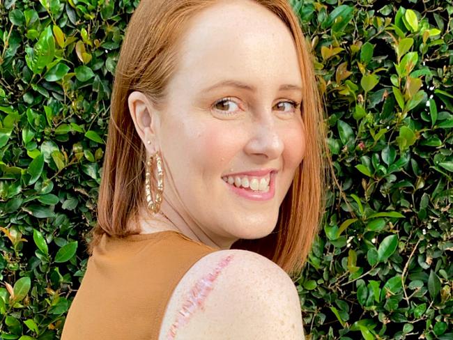 She had it removed – then two-and-a-half years later, she noticed a lump near the initial melanoma spot. Picture: Supplied