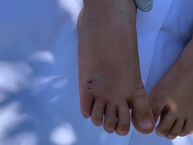 Lisa Fitzgerald's daughter, 2, was bitten by a snake at Jezzine Barracks. The bite mark can be clearly seen. Photo: Facebook