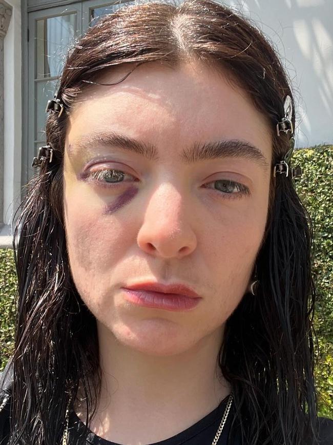 The singer didn’t explain the reason for her injury.