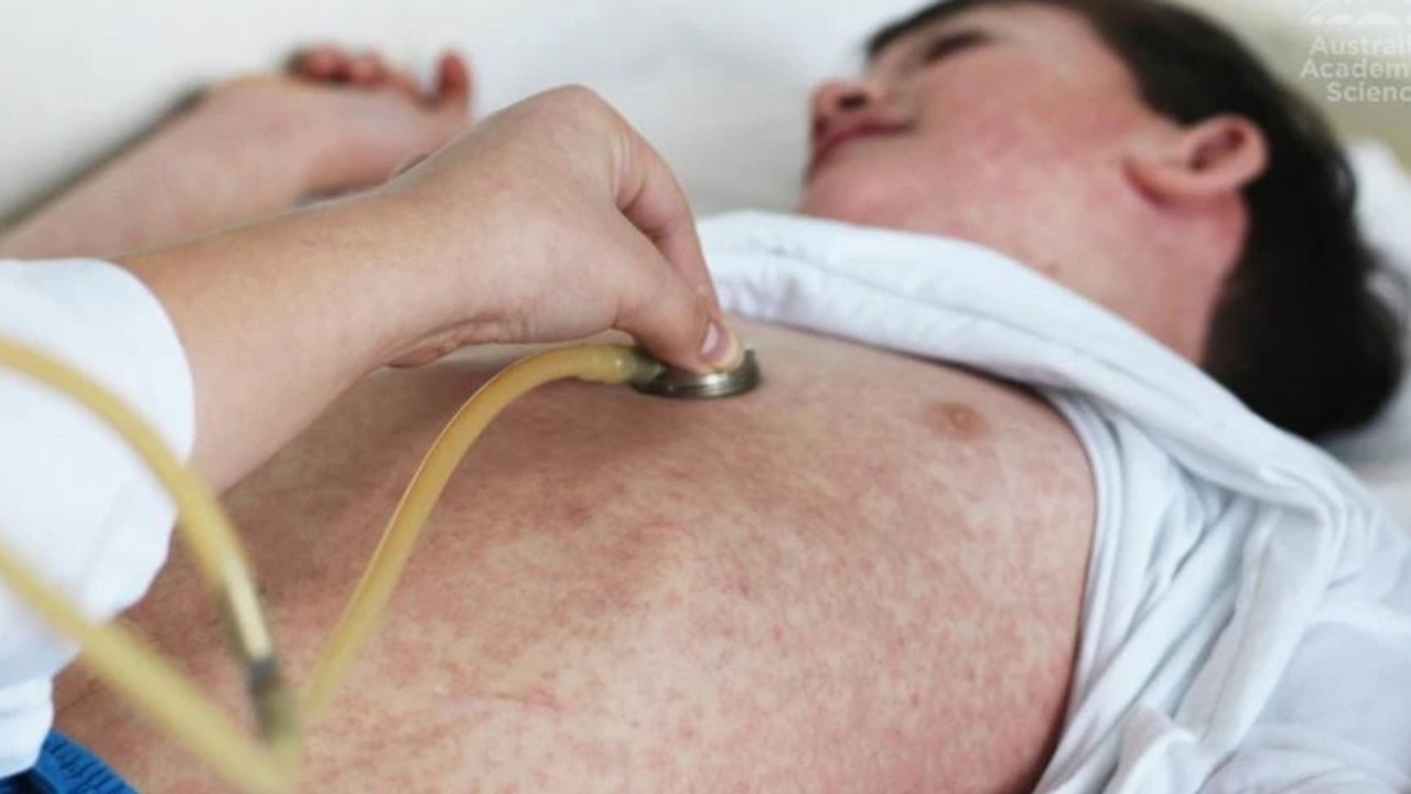 Early symptoms of measles include fever, tiredness, cough, runny nose, and sore eyes, followed by a red non-itchy rash three or four days later. Picture: ACS