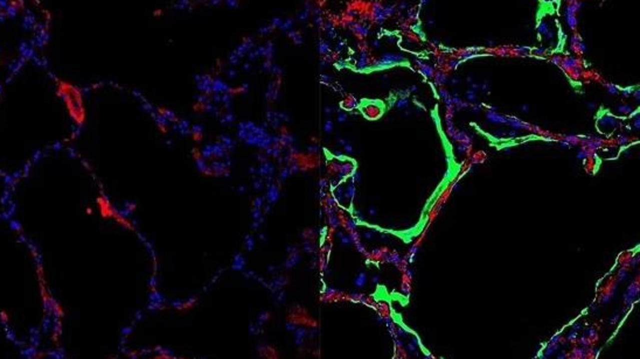 On the left is a healthy control lung, wihile on the right is post mortem lung tissue from soemone who died from Covid - with teh newly disocered LRRC15 receptor shown in green. Picture: Loo and Waller et al