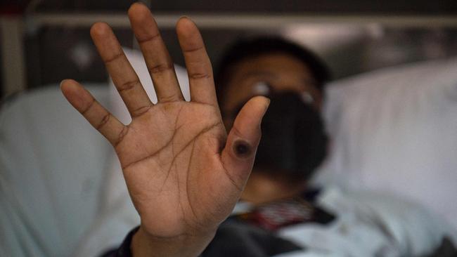 A patient shows his hand with a sore caused by an infection of the monkeypox virus. Picture: AFP