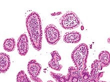 Non Hodgkin-lymphoma generic for thumbnail