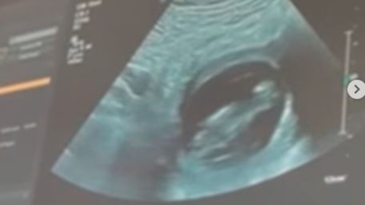 An ultrasound of the couple's unborn baby.