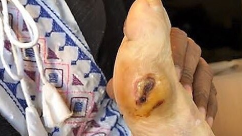 In a previous case in Australia, a Victorian patient was found to have eight maggots in a wound in her foot. Picture: Supplied