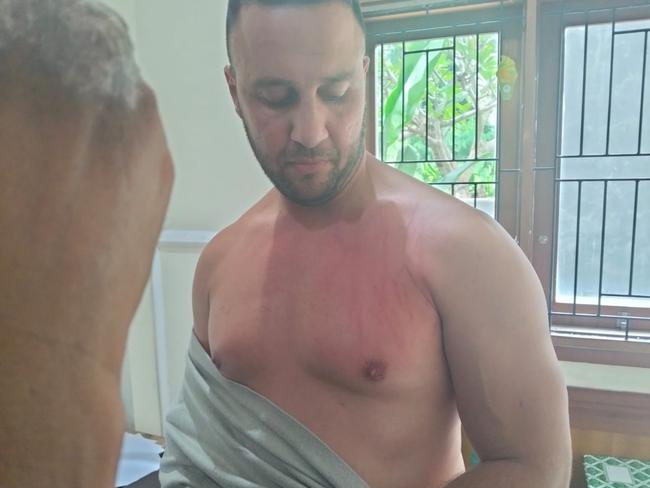 Ali Shahrouk released a photograph of his chest which he claims was scratched by a German tourist in Bali. Picture: Supplied