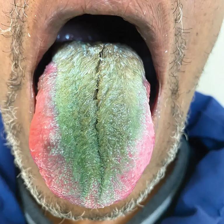 Smoker s tongue turns green spouts hair after rare reaction to