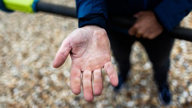 Wardley’s hands showing the brunt of her new passion.