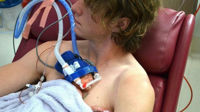 Liam Picken holds his premature daughter Cheska on his chest.