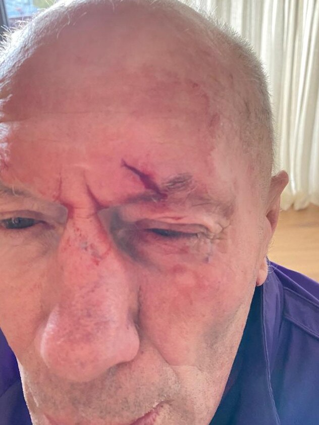 Don Scott reveals his wound after an accident last month.