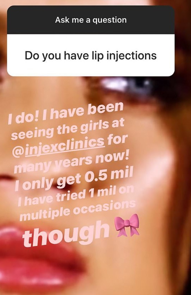 In a Q&A on Instagram, she confirmed the rumours about her lip treatment were true. 