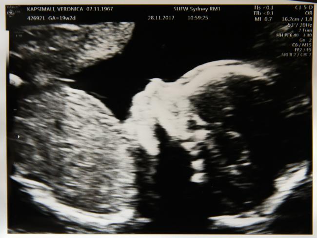 An early glimpse of Harry via an ultrasound picture.