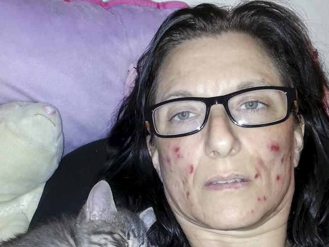 Linda Smith has a skin picking condition so bad that she believes her only hope is to be placed into a medically-induced coma so that her wounds can heal.