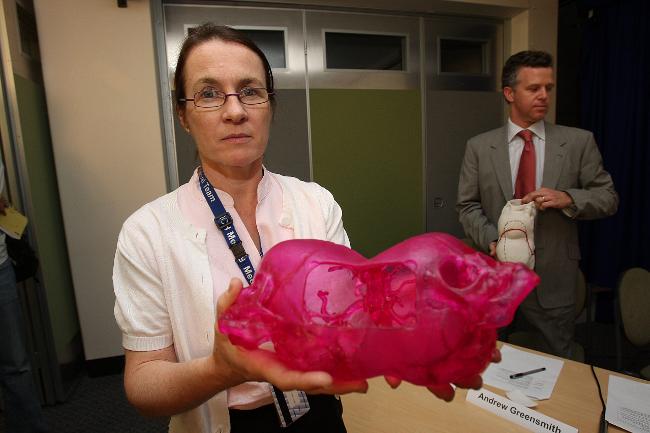 <p>Neurosurgeon Wirginia Maixner with a cast of the twins' skulls during a media briefing before the surgery at the Royal Children's Hospital. Picture: David Caird</p>