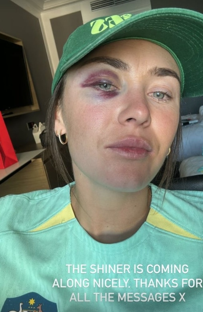 Matildas striker Caitlin Foord has taken to social media to show off her black eye. Picture: Instagram