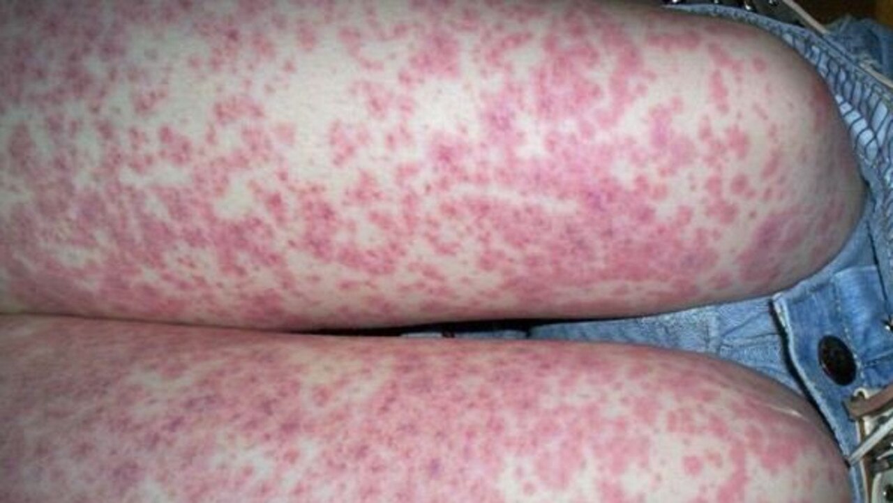 Parents are told to be on the lookout for purple blotches on the skin that retain their colour when pressed