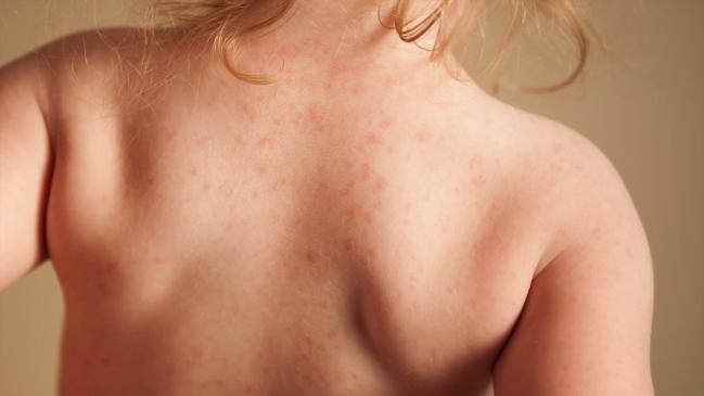 Toddler rash on back of neck and shoulders