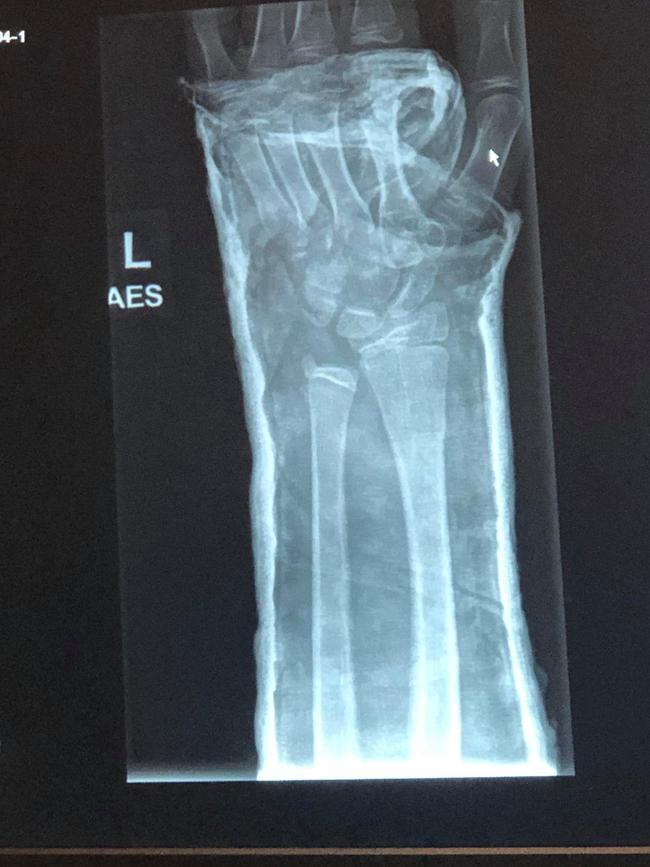 An x-ray showing Chloe Uttley's broken wrist.