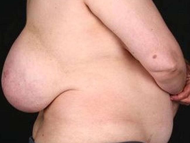 Woman has 'breast' on her back   — Australia's leading