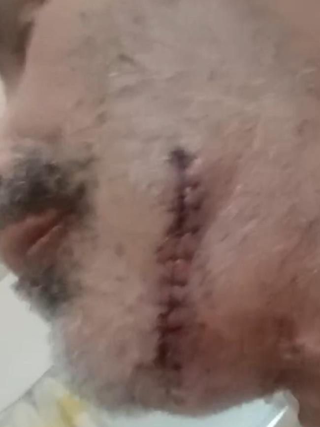 Chris Herbert’s lacerated jaw. Picture: Supplied