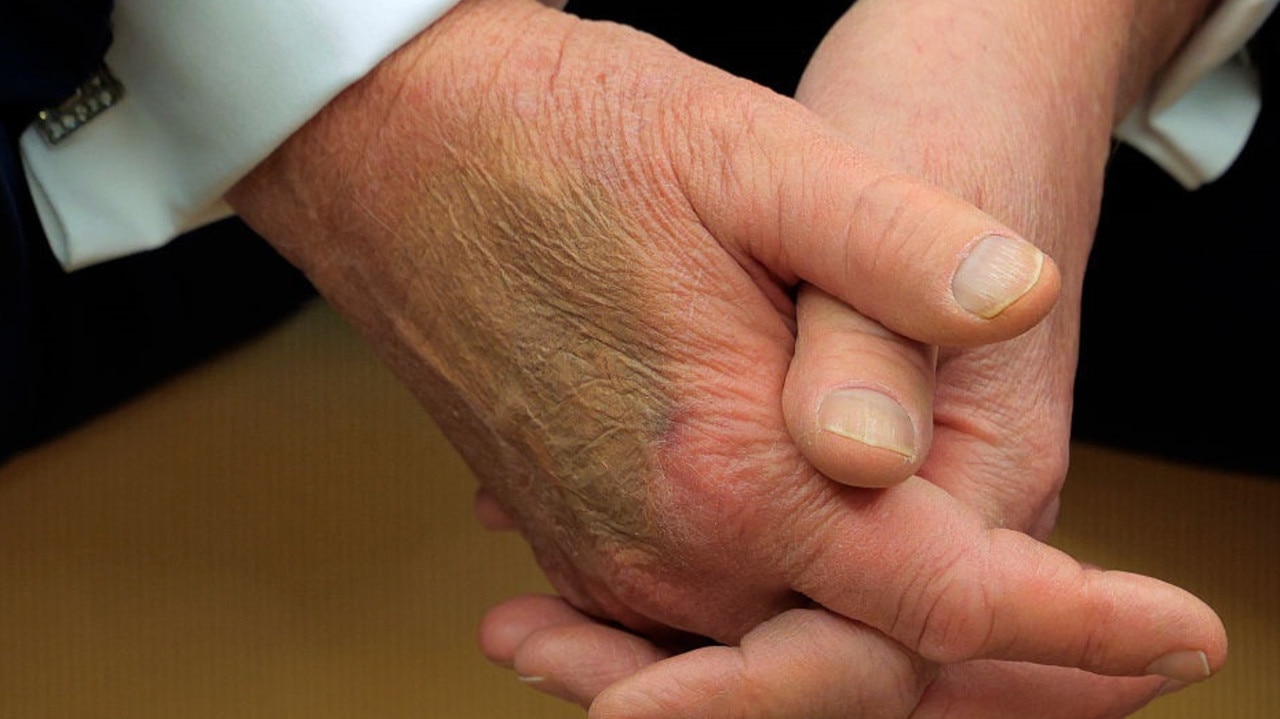 Makeup appears to covers a bruise on the back of US President Donald Trump's hand as he hosts French President Emmanuel Macron for meetings at the White House on February 24, 2025 in Washington, DC. (Photo by Chip Somodevilla/Getty Images)