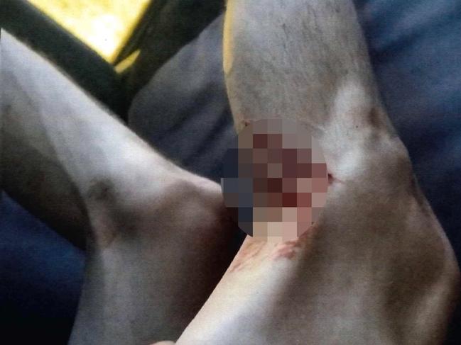 Stab wounds suffered by Jack Brearley, 23, who is one of four people accused of murdering Cassius Turvey. Mr Brearley alleges he received stab wounds from Cassius Turvey before the schoolboy was fatally struck by co-accused Brodie Palmer, an allegation Palmer denies. Picture: WA Police,